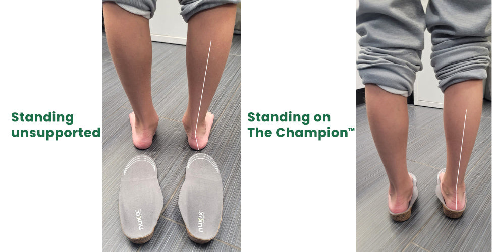 Rear view of a child standing without support beside the same child standing on a NUKIX Champion insole